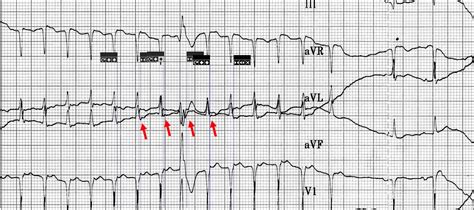 ECG Rhythms: The effect of a spontaneous PVC in a supraventricular ...