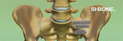 Ifuse Implant System