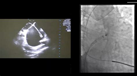 Left Atrial Appendage Closure By Watchman Flx And Ice Youtube