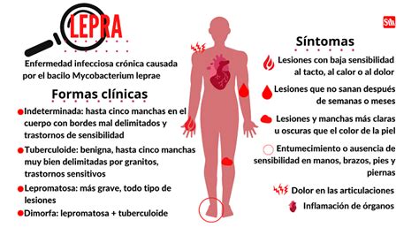 Lepra Tratable Y Curable Peri Dico Sierra Maestra