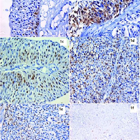 Bladder histology showing non-invasive papillary carcinoma of the ...