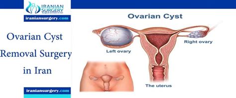 Ovarian Cyst Surgery in Iran | Iranian Surgery