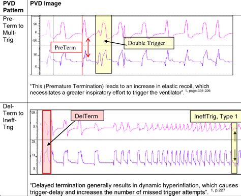 Patient Ventilator Dyssynchrony: Types, Frequency And, 46% OFF