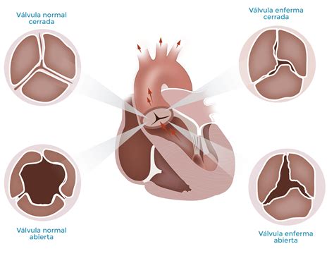 Fisiopatología De La Regurgitación Aórtica