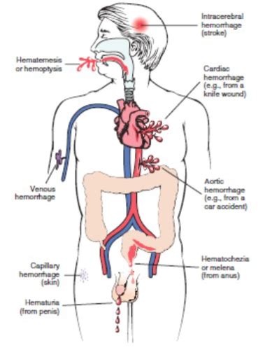 C Edema Hemorrhage Flashcards Quizlet