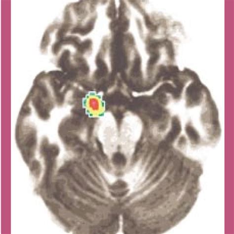 Normalized Relative Regional Cerebral Blood Flow Rcbf In Brain