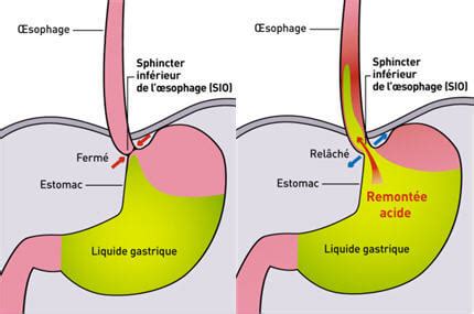 Traitements naturels du reflux gastro œsophagien brûlure d estomac