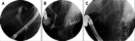 Successful combined endoscopic biliary and duodenal stent placement in ...