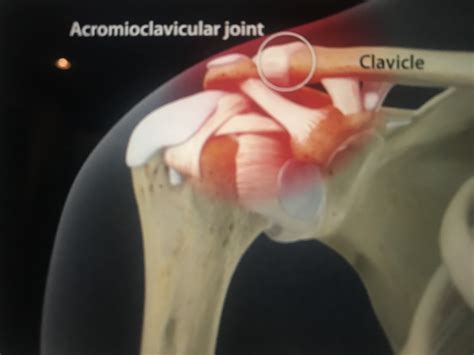 Luxa O Acr Mio Clavicular Ortopedia Ombro Cirurgia Do Ombro E Cotovelo