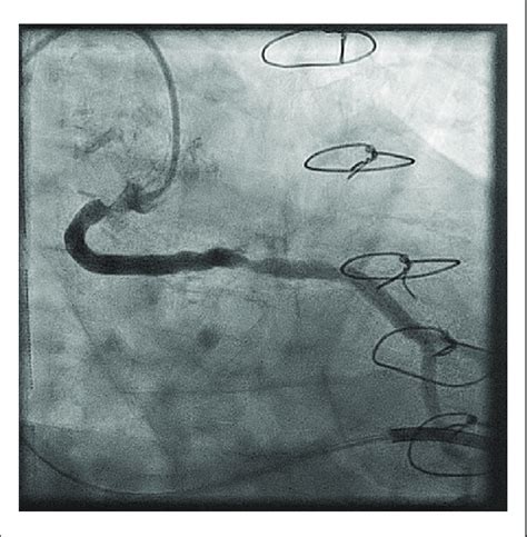 Angiography of the Saphenous Vein Graft With Culprit Occlusions | Download Scientific Diagram