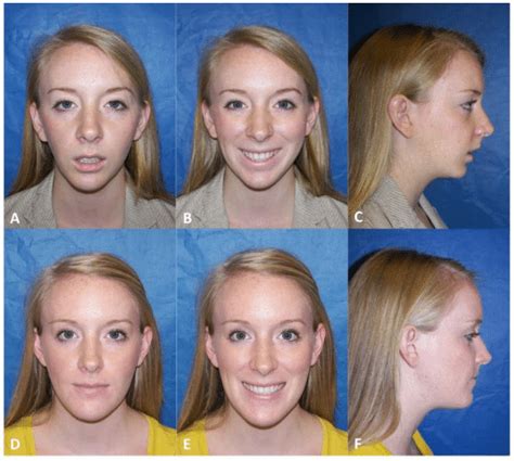 Before and After Photos Maxillofacial Surgery - Larry M. Wolford, DMD