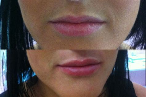 Увеличение объема губ. | Губы