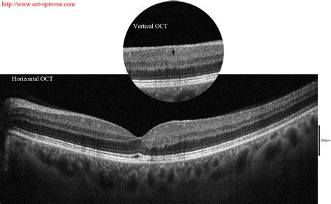 OCT angiography & macular telangiectasia