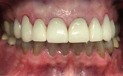 Esthetic Management of Tetracycline-Induced Staining - Decisions in ...