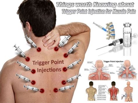 Local And Trigger Point Injections Vic Pain Management