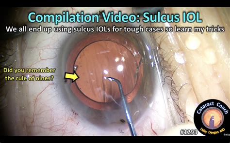 1293 Compilation Video Sulcus IOL Cataract Coach