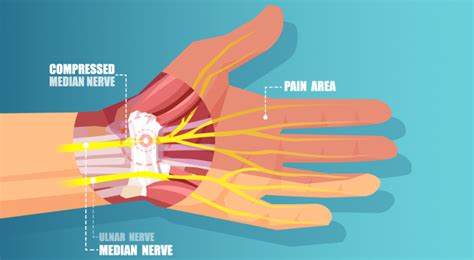 5 Symptoms Of Carpal Tunnel Syndrome Pbworks