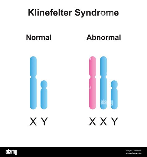 Diagrama Del Sindrome De Klinefelter