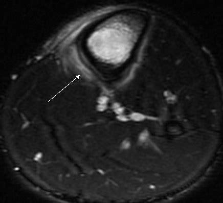 Tibial Stress Fracture-MRI - Sumer's Radiology Blog