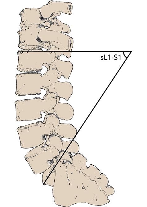 A Call For Consistent Radiographic Definition Of Lumbar Lordosis In