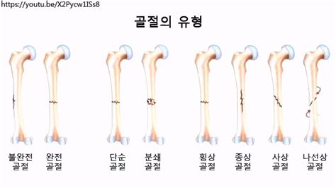 아이플러스 후기와 건강정보 골절