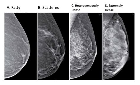 Breast Density Explained By Professor Zoe Winters