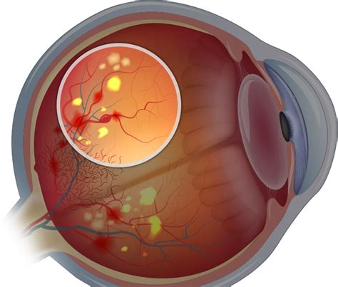 Diabetic Retinopathy Surgery