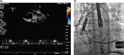 Echocardiographic Assessment Of Left Ventricular Assist Device Outflow Velocity During