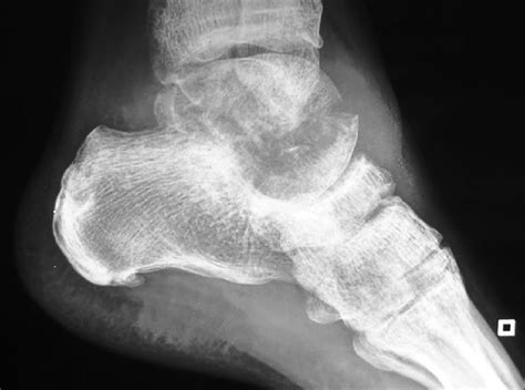 X Ray Left Foot And Ankle Image Showing Lytic Lesion In The Talus With Download Scientific