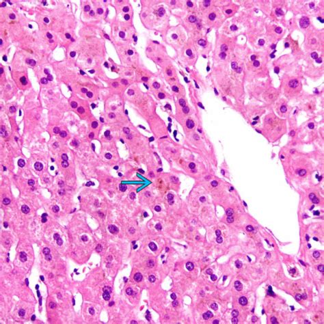 Drug-Induced Cholestatic Liver Injury | Basicmedical Key