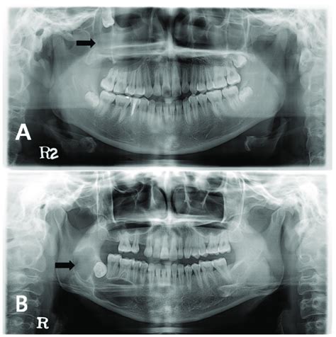 Radiographic Image Of Odontogenic Keratocyst OKC A Patient With An