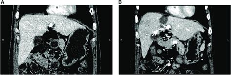 Contrast Enhanced Computed Tomography Images Show Intrahepatic