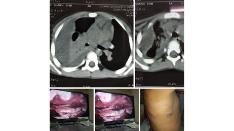 Dr Devendra Taide Pneumonia Empyema Thoracotomy