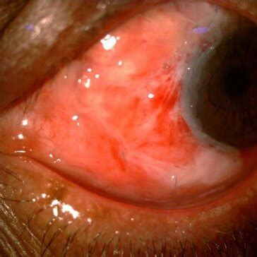 Preoperative A And Postoperative B Fd Oct Showing Scar As