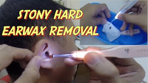 Stony Hard Ear Wax Removal Impacted Cerumen Youtube