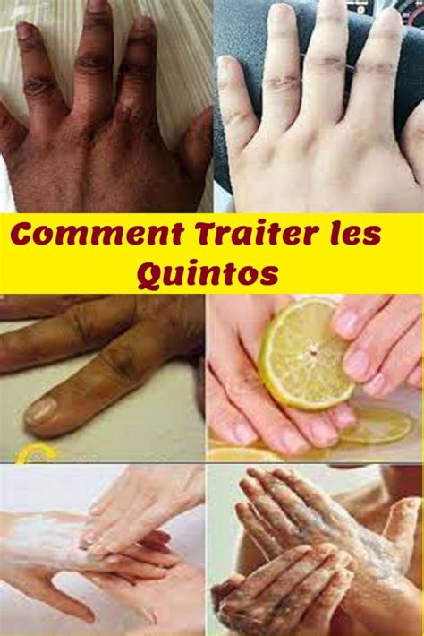 Traiter Les Quintos Comment Claircir Les Phalanges Des Mains