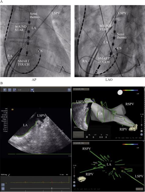 Direct Left Atrial Ice Imaging Guided Ablation For Atrial Fibrillation