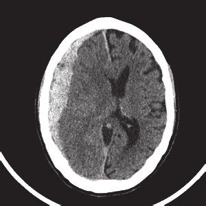 First CT scan. The initial CT scan demonstrates an acute subdural ...