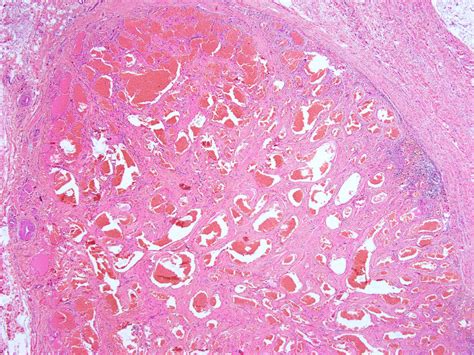 Pathology Outlines Hemangioma Variants