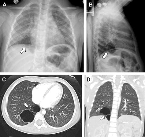 Respiratory Distress In Neonates Radiologic Clinics