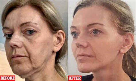 Botox Before And After 40 Year Old Before And After