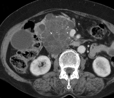 Typical And Atypical Manifestations Of Serous Cystadenoma Of The