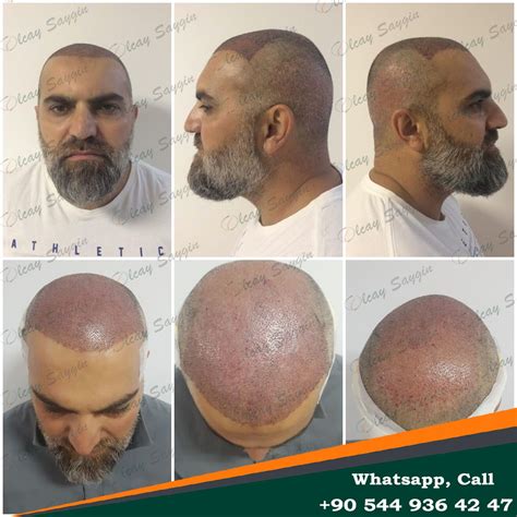 Hair Transplant Uk Hair Transplant Turkey Olcay Saygin Euro Zen