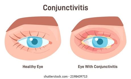 Conjunctivitis Diseases Human Eye Viral Bacterial Stock Vector Royalty