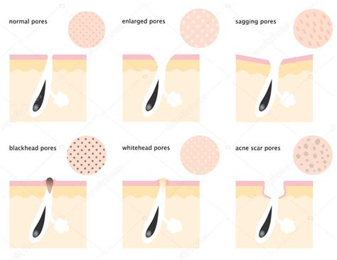 large pores  breasts