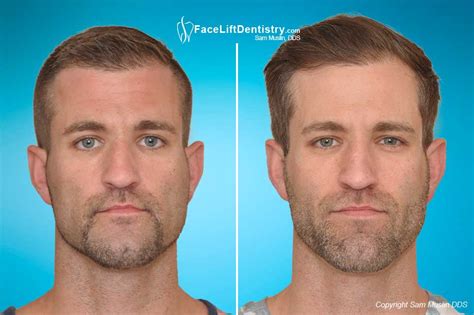 The Misaligned Jaw Symptoms And Treatment