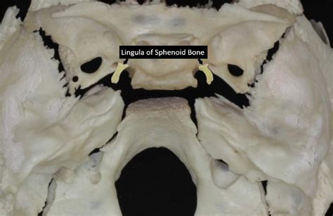 Neurosurgical Atlas On Twitter The Lingual Process Of The Sphenoid