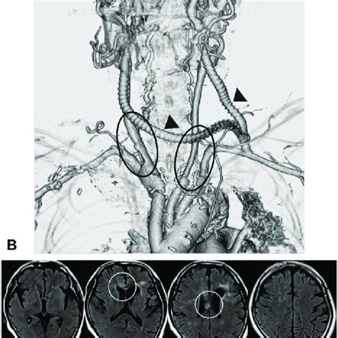 (A) Left subclavian-bilateral external carotid artery bypass was ...