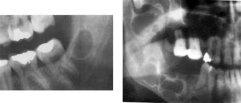 Bohns Nodules Radiograph