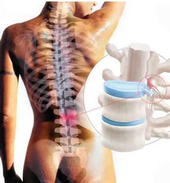 Tratamiento De La Hernias Discales Con Ozono Tratamiento Hernia Discal